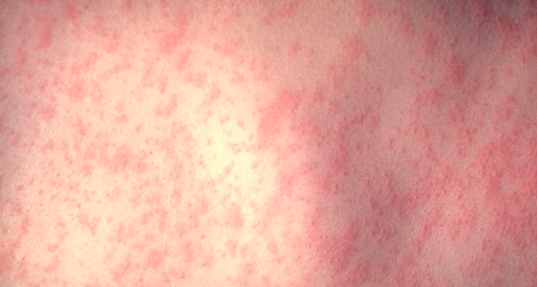 Measles outbreak involving cases at a Philadelphia day care center expands, health officials say